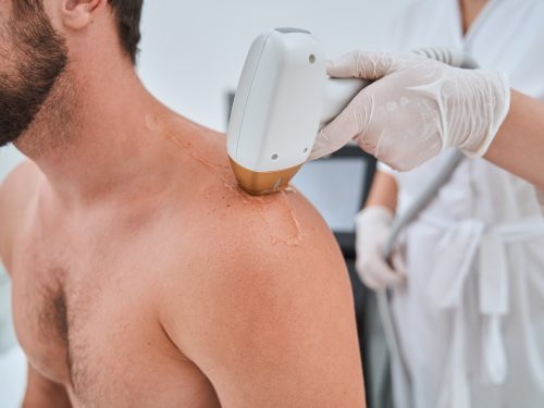 Depilación láser Valencia