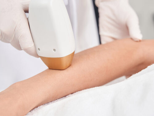 Depilación láser Valencia