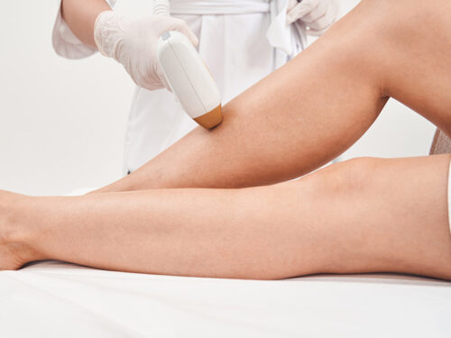 Depilación láser valencia