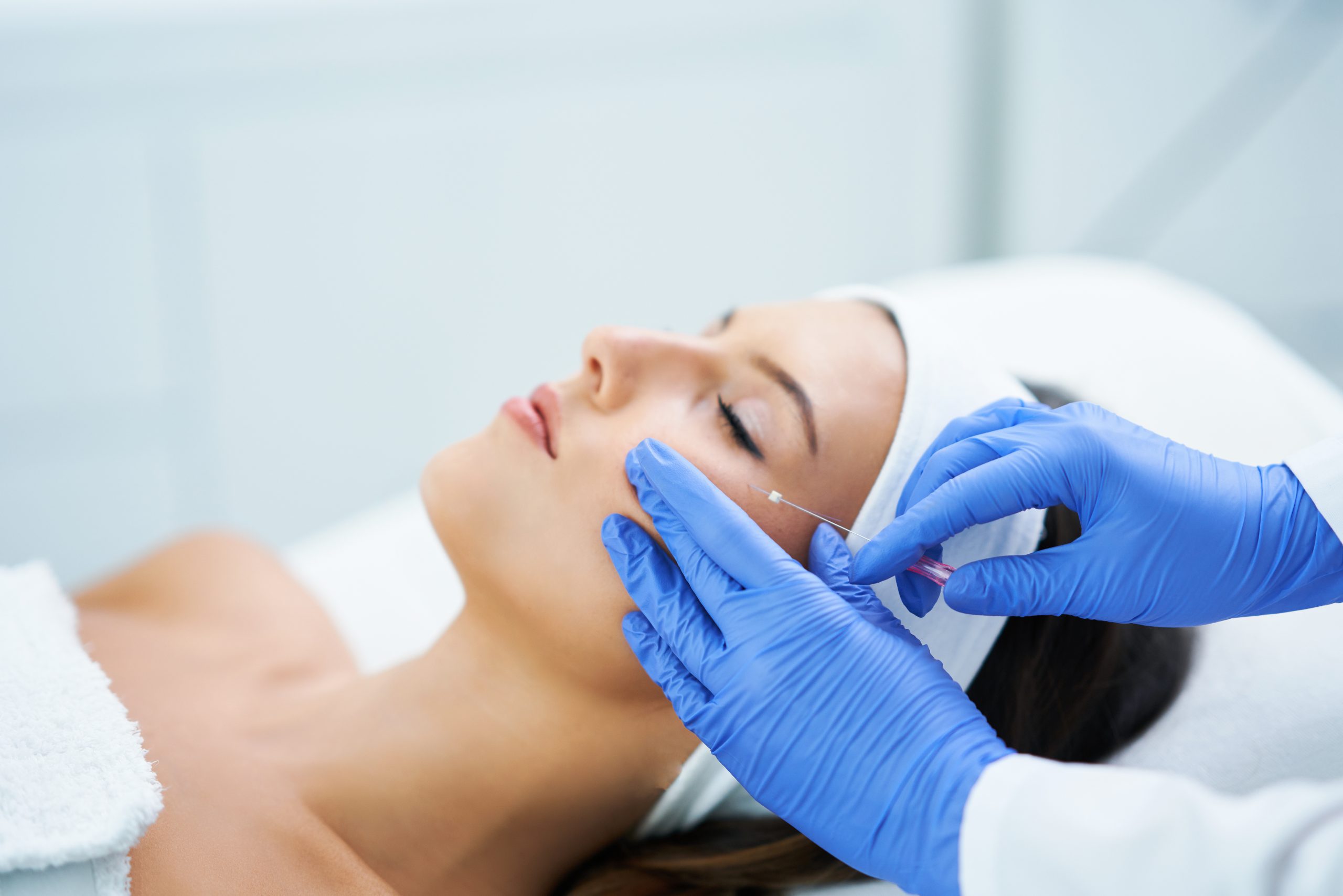¿Lifting facial sin cirugía? Sí, con el tratamiento de hilos tensores.
