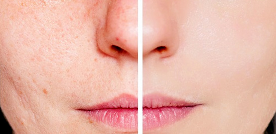 Como eliminar las manchas o acné