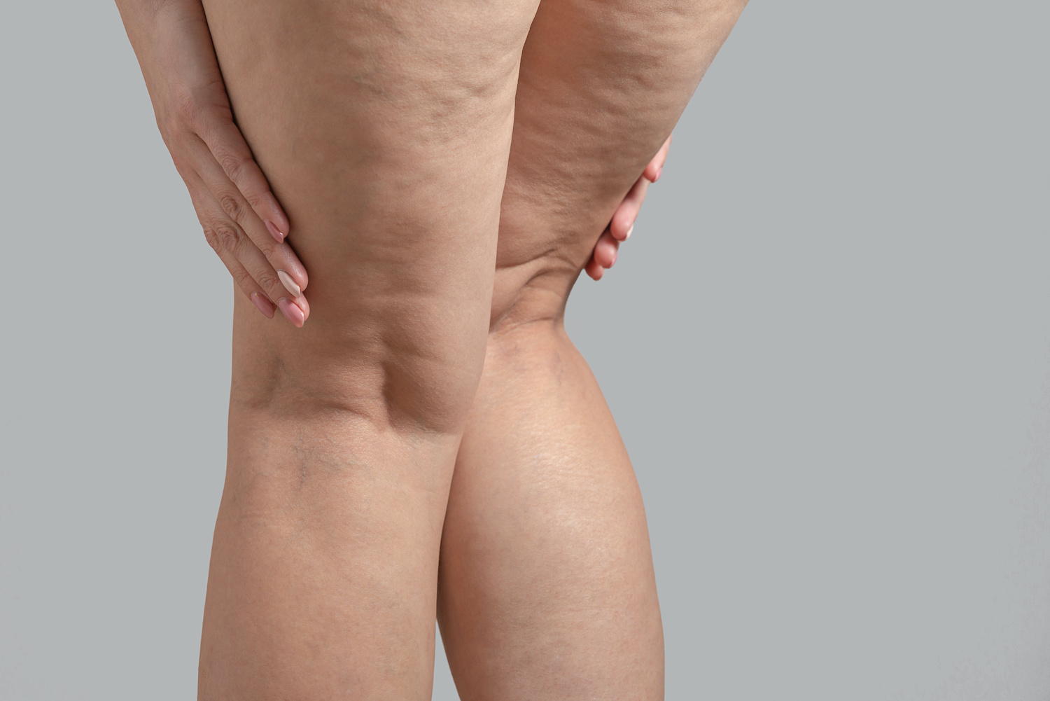 ¿Sabes qué tipo de celulitis tienes? 
