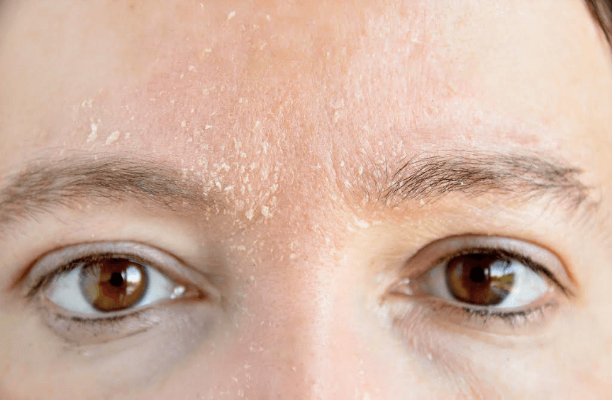 ¿Caspa o Dermatitis Seborreica?