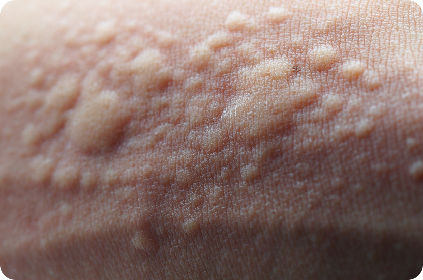 Urticaria Campuslaser