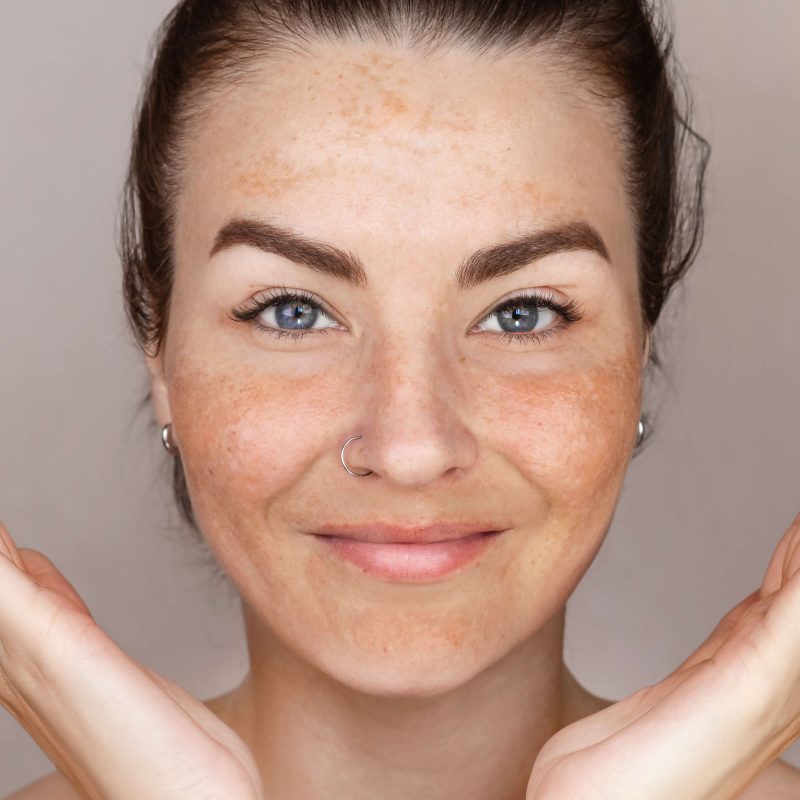 tratamiento melasma valencia