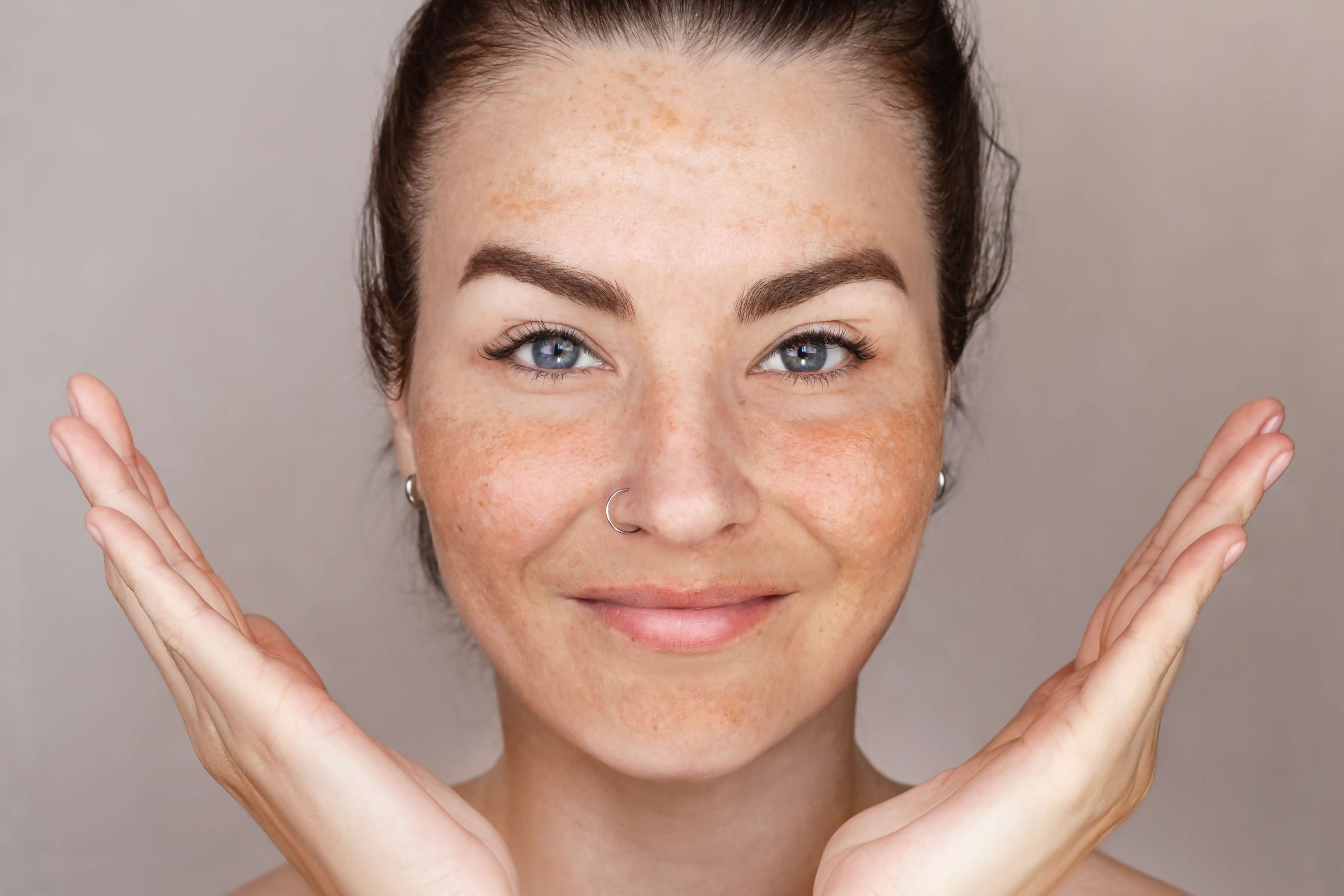 Melasma: Origen y tratamiento