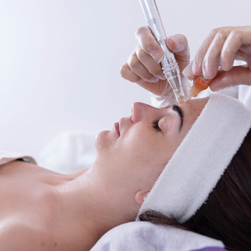 Microneedling y Exosomas