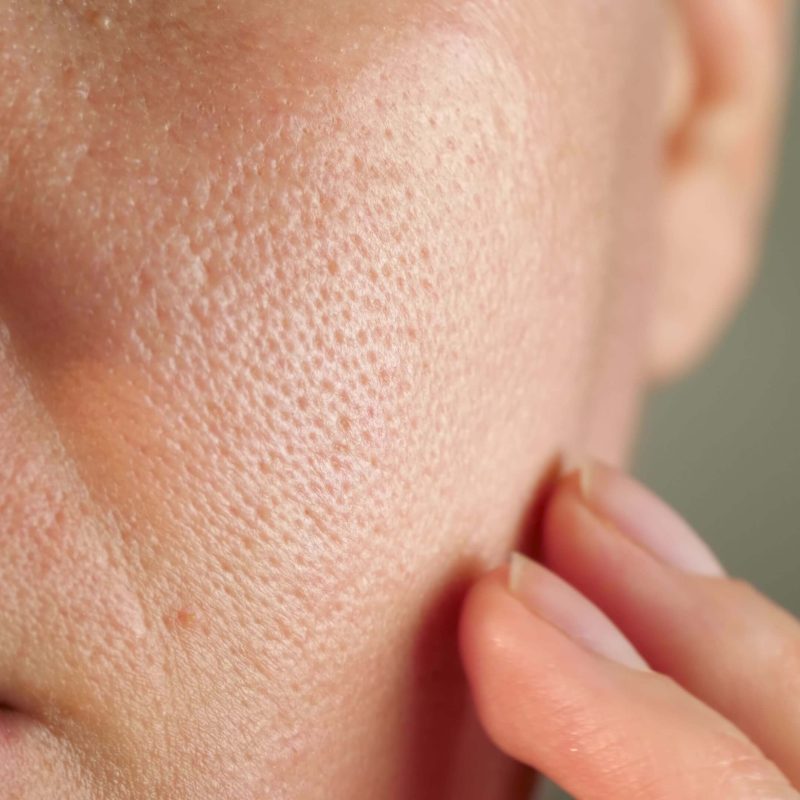 luz pulsada valencia