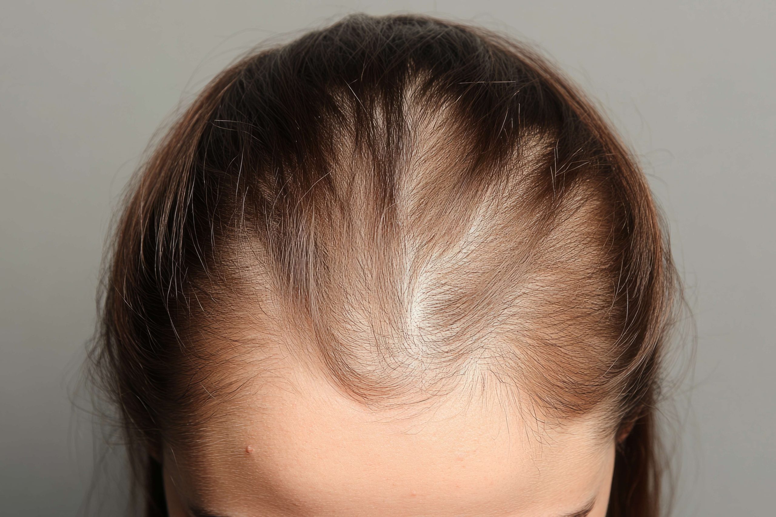 Alopecia Frontal Fibrosante