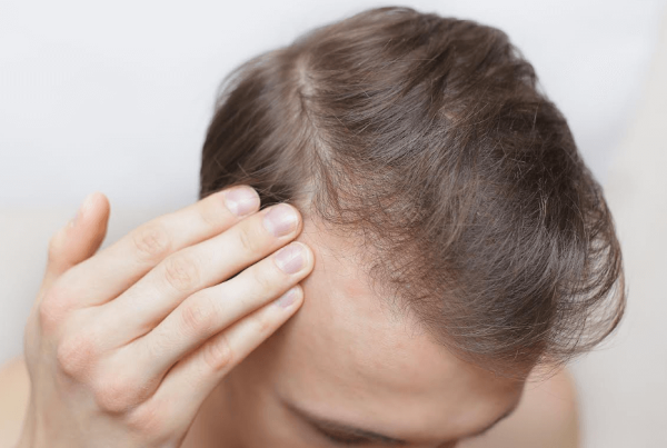 alopecia androgenetica valencia