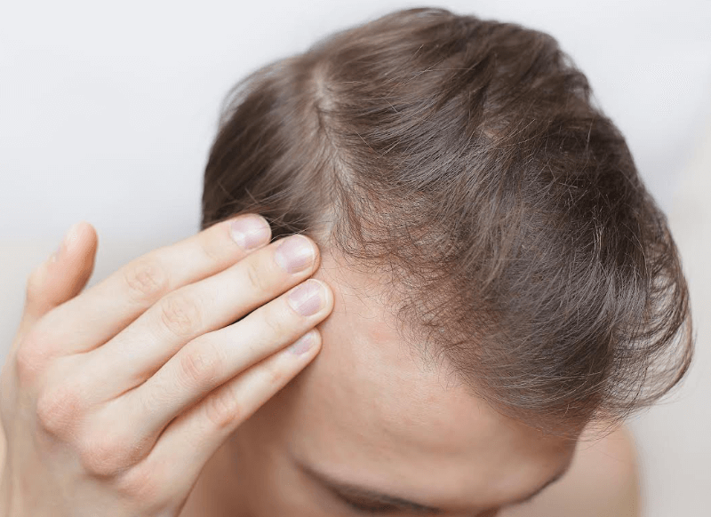 alopecia androgenetica valencia
