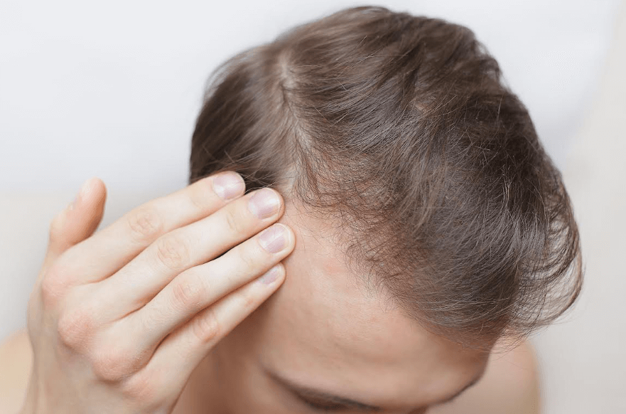 alopecia androgenetica valencia