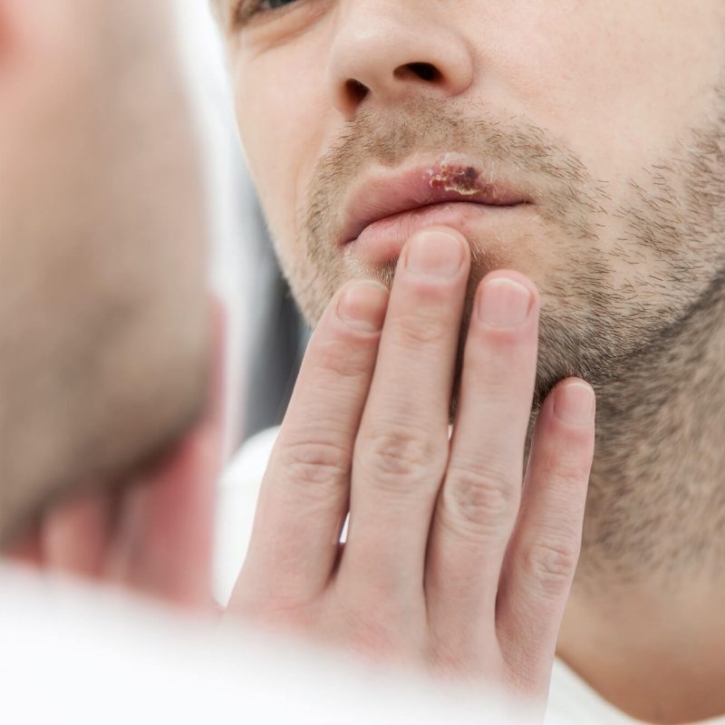 herpes hongos tratamiento valencia