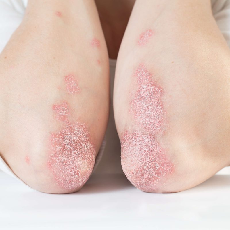 PSORIASIS y frio