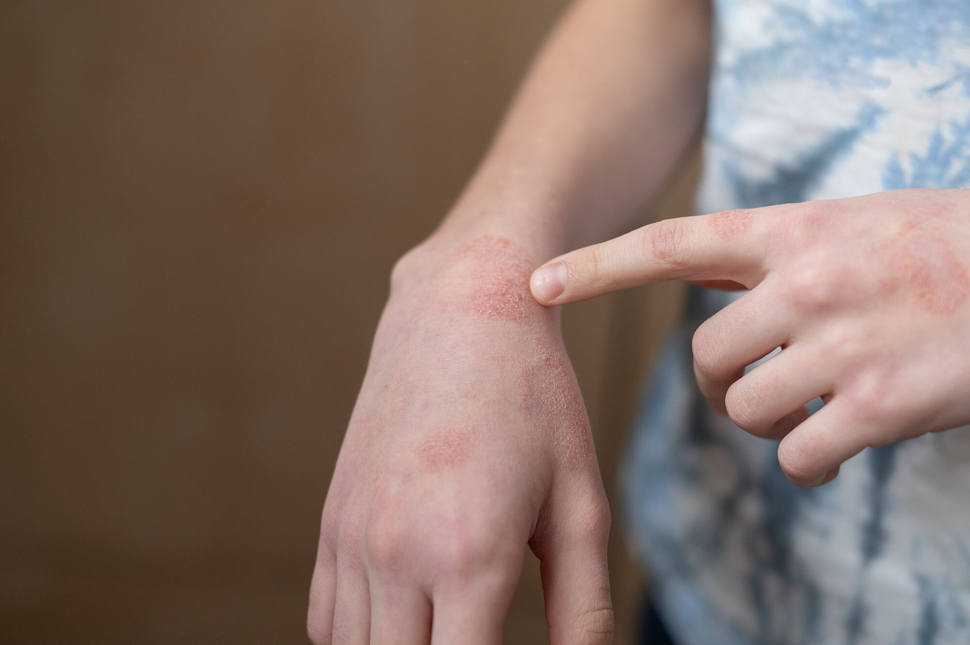 dermatitis atopica